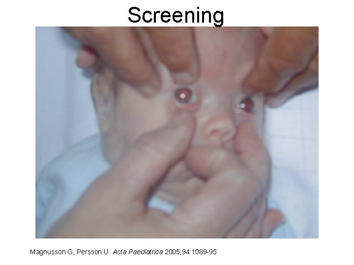 Screening Magnusson G, Persson U. Acta Paediatrica 2005; 94: 1089 -95 