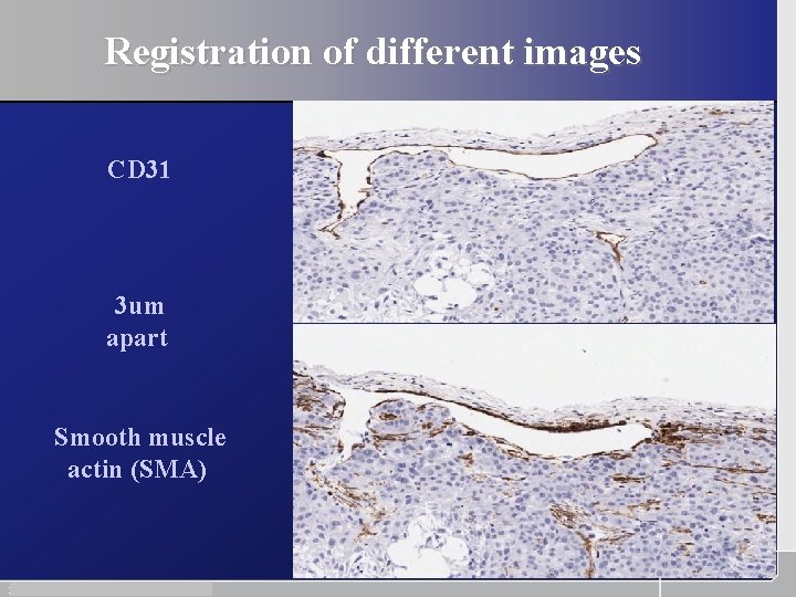 Registration of different images CD 31 3 um apart Smooth muscle actin (SMA) 29