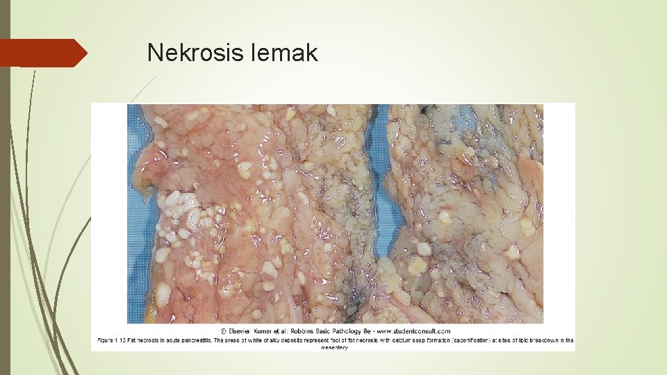 Nekrosis lemak 