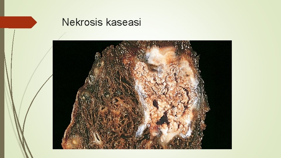 Nekrosis kaseasi 