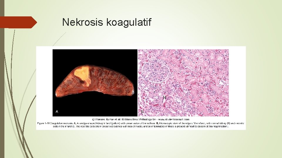 Nekrosis koagulatif 