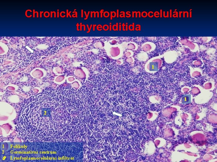 Chronická lymfoplasmocelulární thyreoiditida 1 1 2 1 Folikuly 2 Germinativní centrum Lymfoplasmocelulární infiltrát 