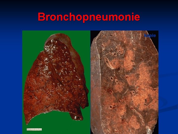 Bronchopneumonie kopie 