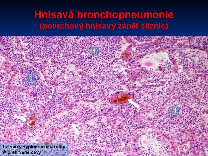 Hnisavá bronchopneumonie (povrchový hnisavý zánět sliznic) 1 1 alveoly vyplněné neutrofily překrvené cévy 