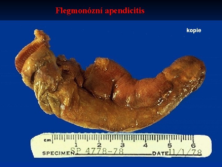 Flegmonózní apendicitis kopie 