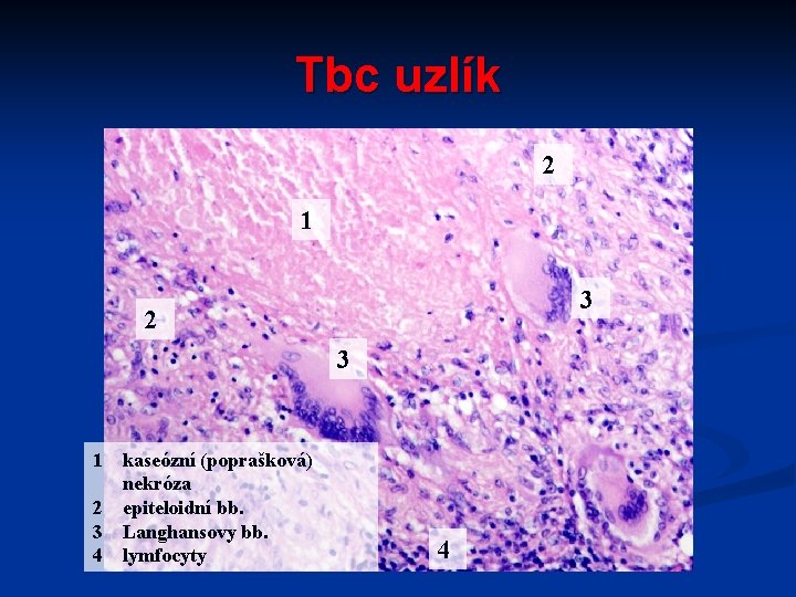 Tbc uzlík 2 1 3 2 3 1 kaseózní (poprašková) nekróza 2 epiteloidní bb.