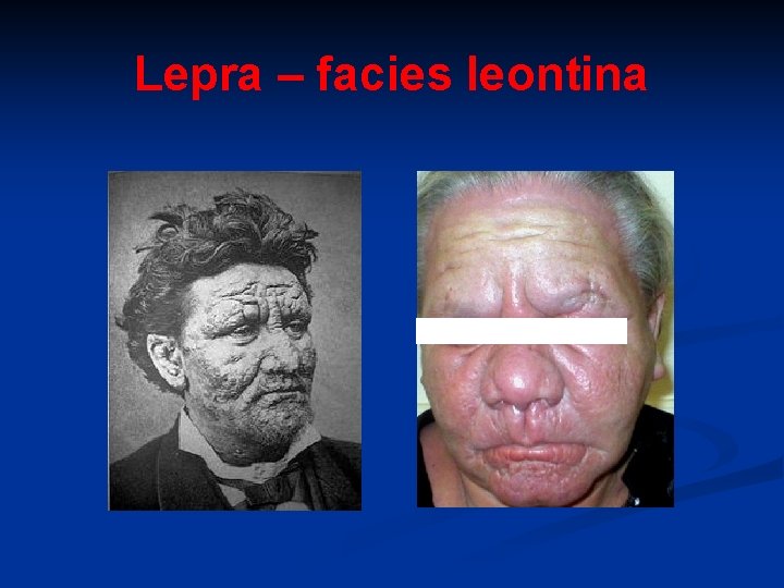 Lepra – facies leontina 