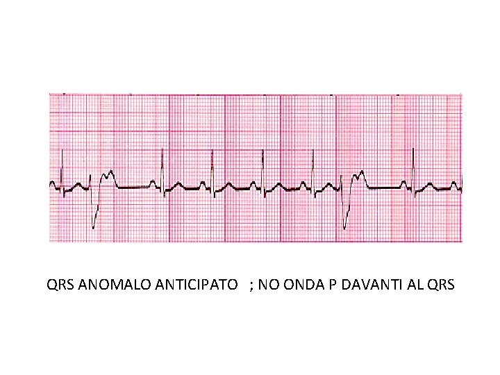 QRS ANOMALO ANTICIPATO ; NO ONDA P DAVANTI AL QRS QRS ANOMALO ANTICIPATO ; NO ONDA P DAVANTI AL QRS