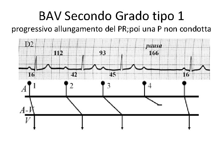 BAV Secondo Grado tipo 1 progressivo allungamento del PR; poi una P non condotta BAV Secondo Grado tipo 1 progressivo allungamento del PR; poi una P non condotta