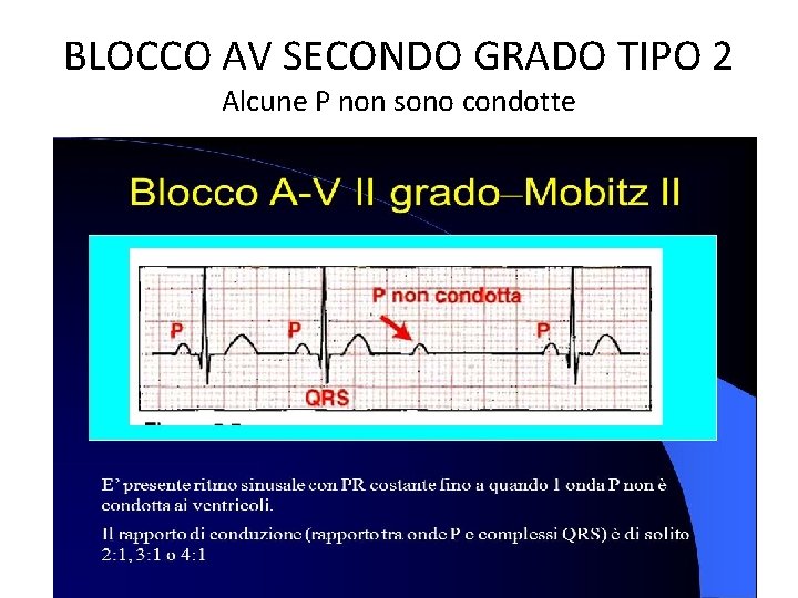 BLOCCO AV SECONDO GRADO TIPO 2 Alcune P non sono condotte BLOCCO AV SECONDO GRADO TIPO 2 Alcune P non sono condotte
