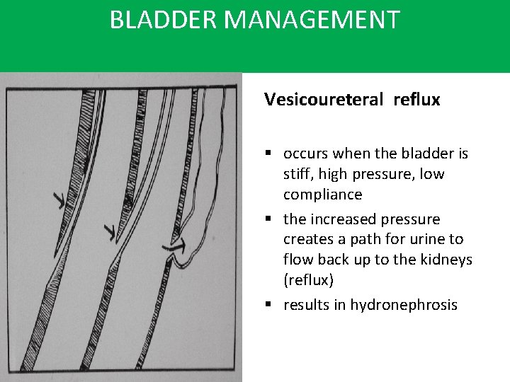 BLADDER MANAGEMENT Vesicoureteral reflux § occurs when the bladder is stiff, high pressure, low