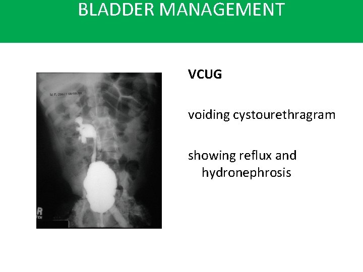 BLADDER MANAGEMENT VCUG voiding cystourethragram showing reflux and hydronephrosis 