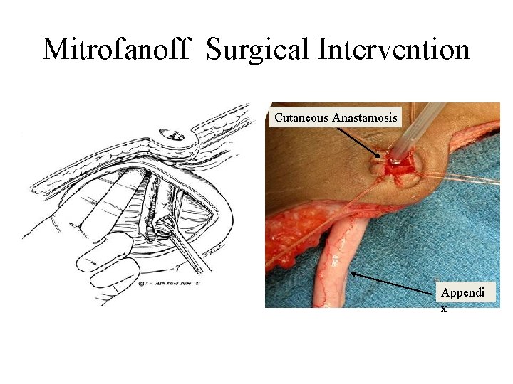 Mitrofanoff Surgical Intervention Cutaneous Anastamosis Appendi x 