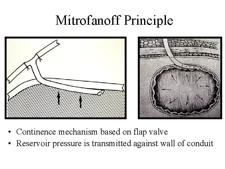 Mitrofanoff Principle • Continence mechanism based on flap valve • Reservoir pressure is transmitted