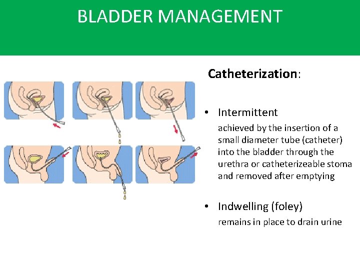 BLADDER MANAGEMENT Catheterization: • Intermittent achieved by the insertion of a small diameter tube