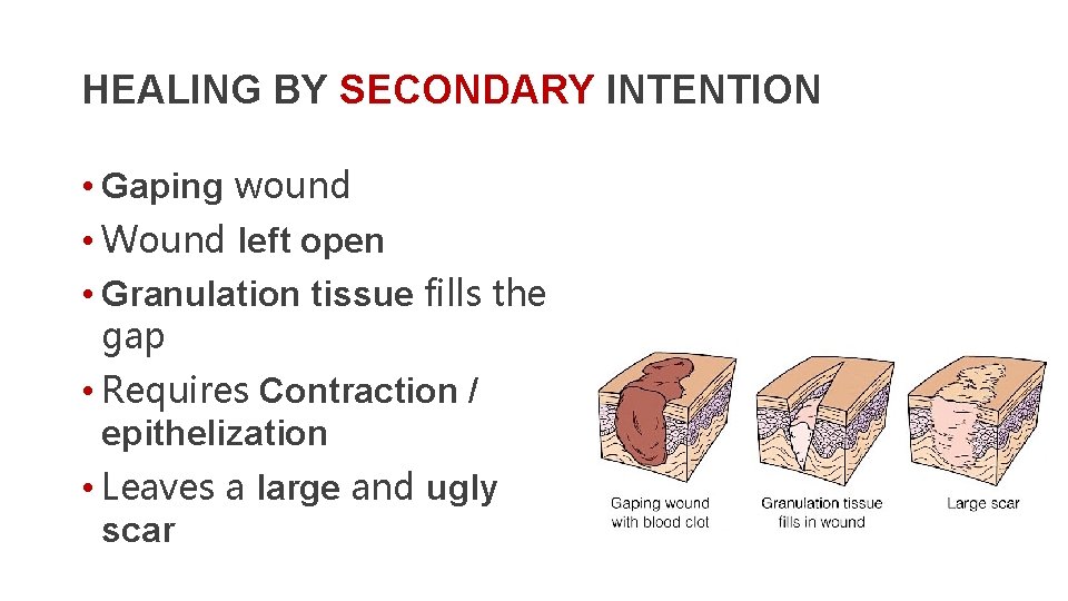 HEALING BY SECONDARY INTENTION • Gaping wound • Wound left open • Granulation tissue