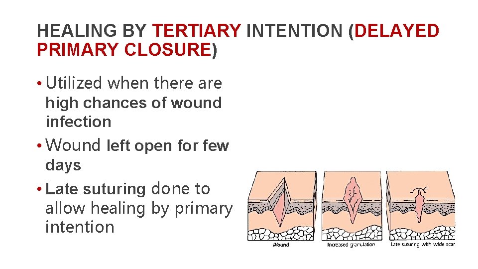 HEALING BY TERTIARY INTENTION (DELAYED PRIMARY CLOSURE) • Utilized when there are high chances
