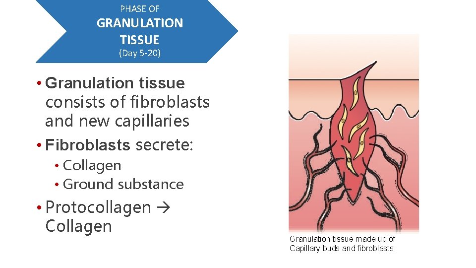 PHASE OF GRANULATION TISSUE (Day 5 -20) • Granulation tissue consists of fibroblasts and