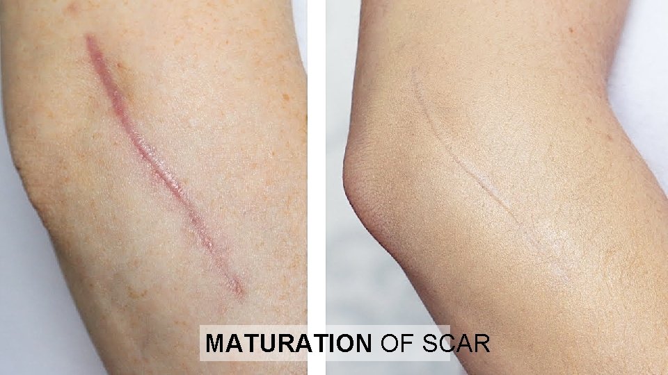 MATURATION OF SCAR 