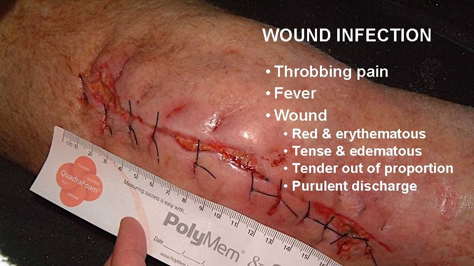 WOUND INFECTION • Throbbing pain • Fever • Wound • Red & erythematous •