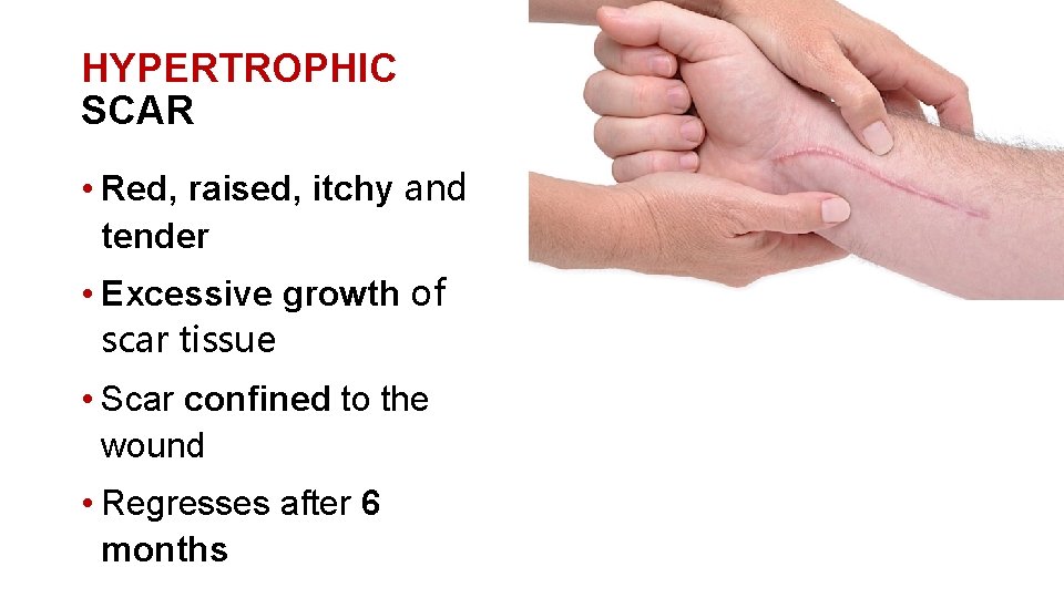 HYPERTROPHIC SCAR • Red, raised, itchy and tender • Excessive growth of scar tissue