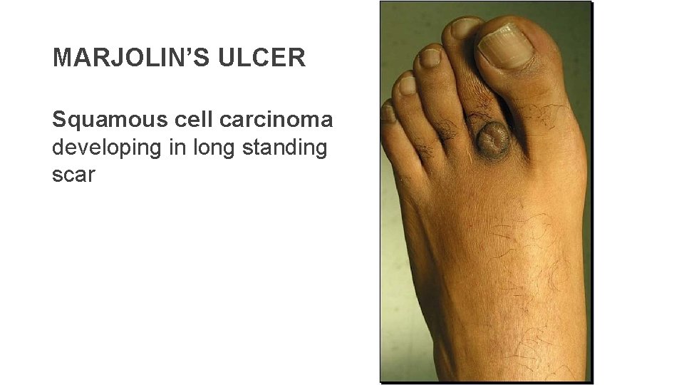 MARJOLIN’S ULCER Squamous cell carcinoma developing in long standing scar 