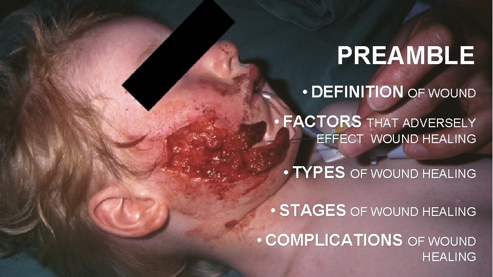 PREAMBLE • DEFINITION OF WOUND • FACTORS THAT ADVERSELY EFFECT WOUND HEALING • TYPES