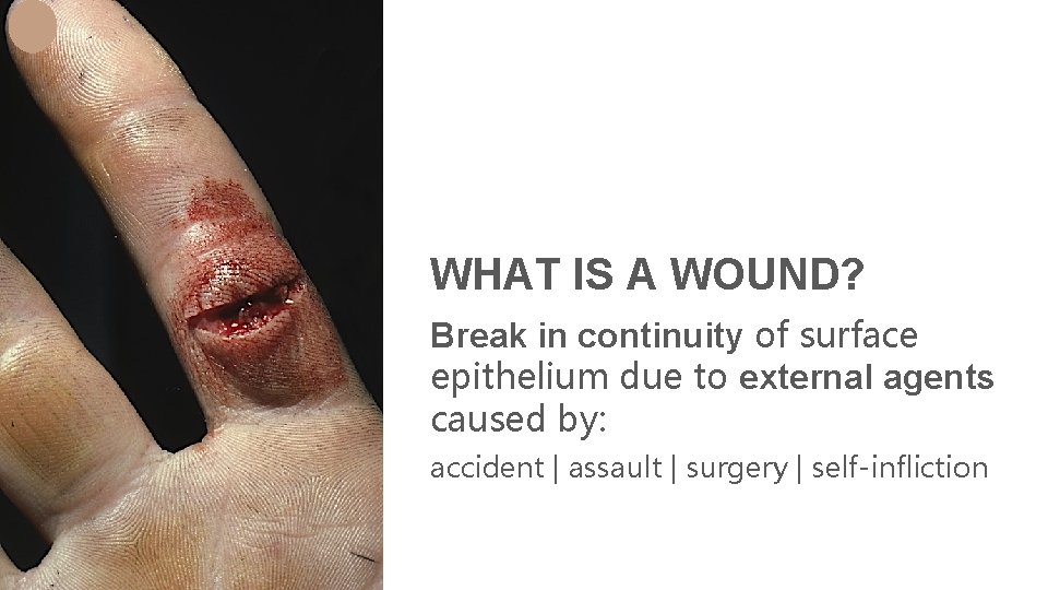 WHAT IS A WOUND? Break in continuity of surface epithelium due to external agents