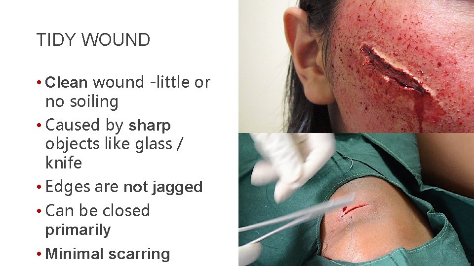 TIDY WOUND • Clean wound -little or no soiling • Caused by sharp objects