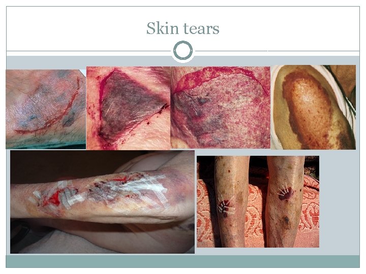 Skin tears 