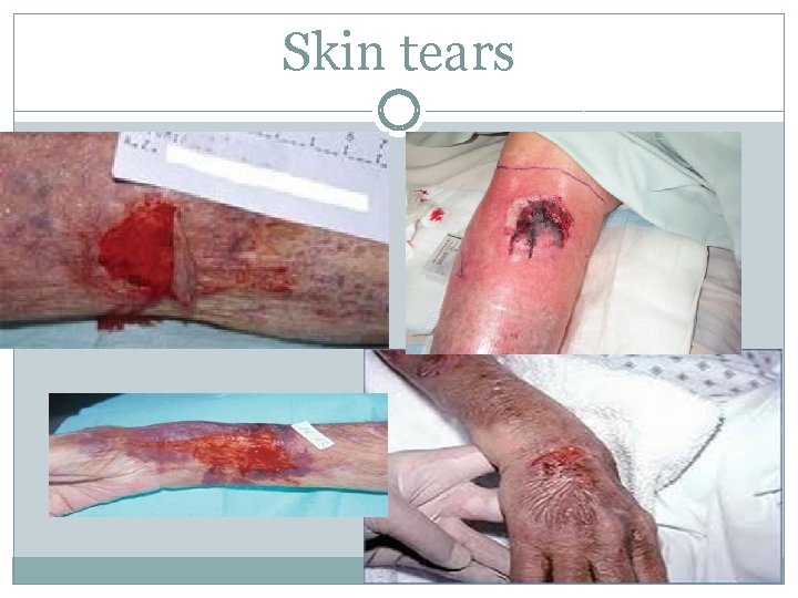 Skin tears 