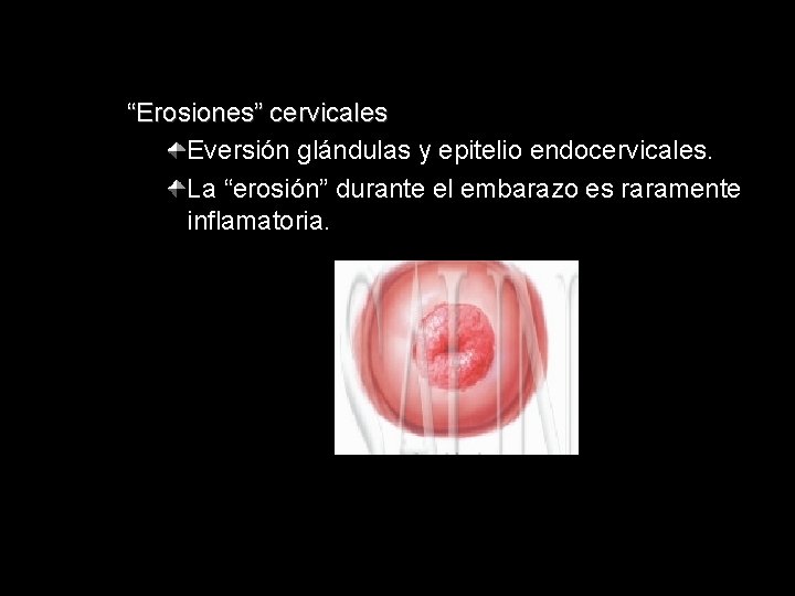 “Erosiones” cervicales Eversión glándulas y epitelio endocervicales. La “erosión” durante el embarazo es raramente