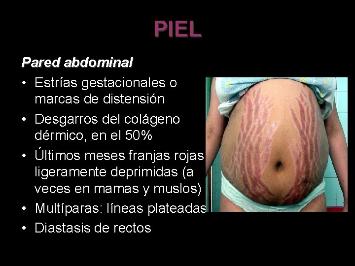 PIEL Pared abdominal • Estrías gestacionales o marcas de distensión • Desgarros del colágeno