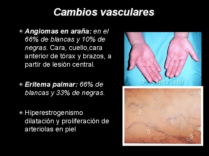 Cambios vasculares Angiomas en araña: en el 66% de blancas y 10% de negras.