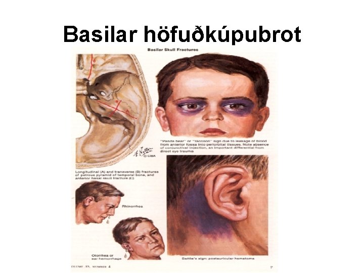 Basilar höfuðkúpubrot 