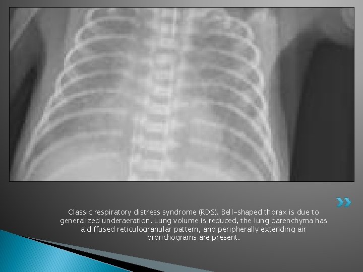 Classic respiratory distress syndrome (RDS). Bell-shaped thorax is due to generalized underaeration. Lung volume