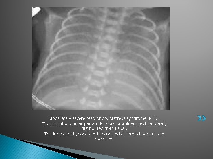 Moderately severe respiratory distress syndrome (RDS). The reticulogranular pattern is more prominent and uniformly