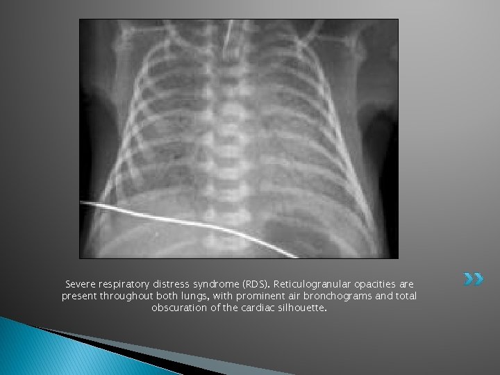 Severe respiratory distress syndrome (RDS). Reticulogranular opacities are present throughout both lungs, with prominent