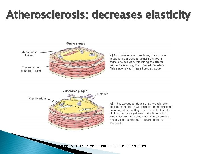 Atherosclerosis: decreases elasticity Figure 15 -24: The development of atherosclerotic plaques Atherosclerosis: decreases elasticity Figure 15 -24: The development of atherosclerotic plaques