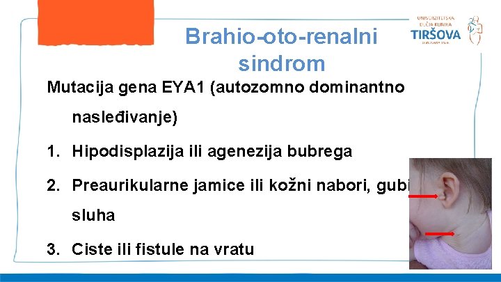 Brahio-oto-renalni sindrom Mutacija gena EYA 1 (autozomno dominantno nasleđivanje) 1. Hipodisplazija ili agenezija bubrega