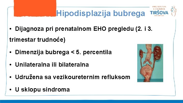 Hipodisplazija bubrega • Dijagnoza pri prenatalnom EHO pregledu (2. i 3. trimestar trudnoće) •