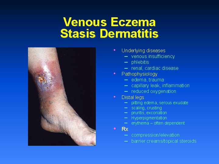 Venous Eczema Stasis Dermatitis • • Underlying diseases – venous insufficiency – phlebitis –