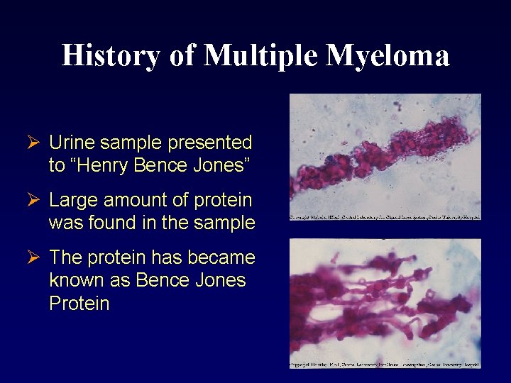 History of Multiple Myeloma Ø Urine sample presented to “Henry Bence Jones” Ø Large