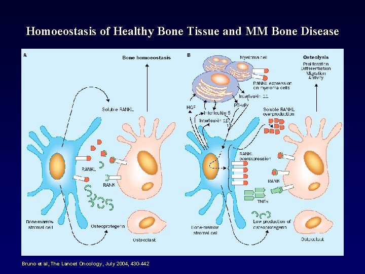 Homoeostasis of Healthy Bone Tissue and MM Bone Disease Bruno et al, The Lancet