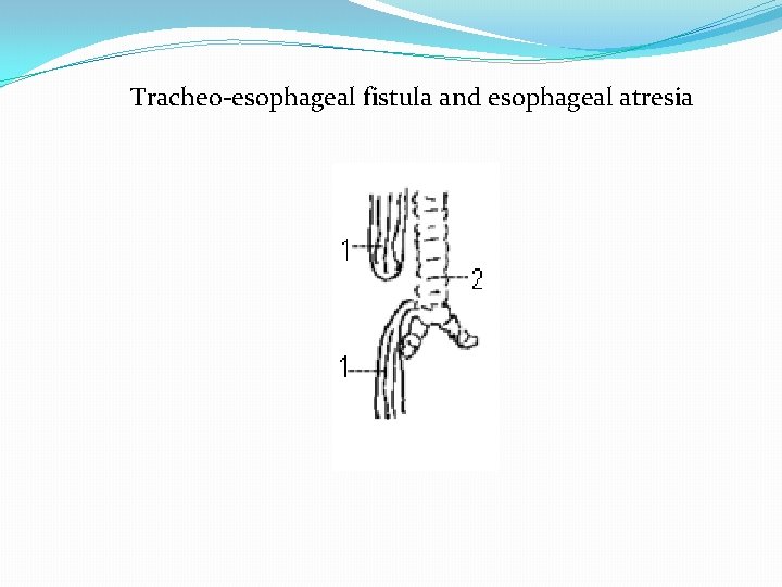 Tracheo-esophageal fistula and esophageal atresia 