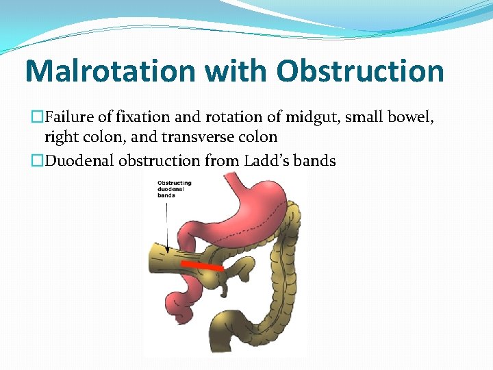 Malrotation with Obstruction �Failure of fixation and rotation of midgut, small bowel, right colon,