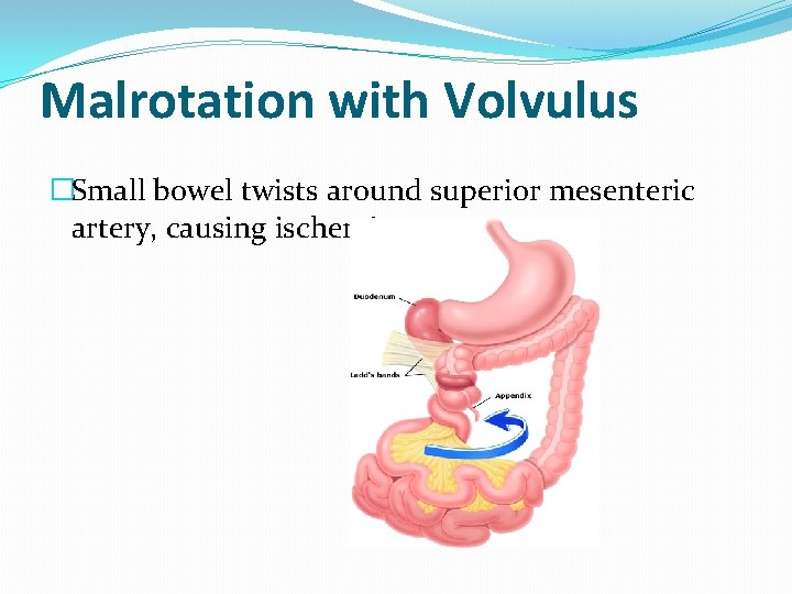 Malrotation with Volvulus �Small bowel twists around superior mesenteric artery, causing ischemia 