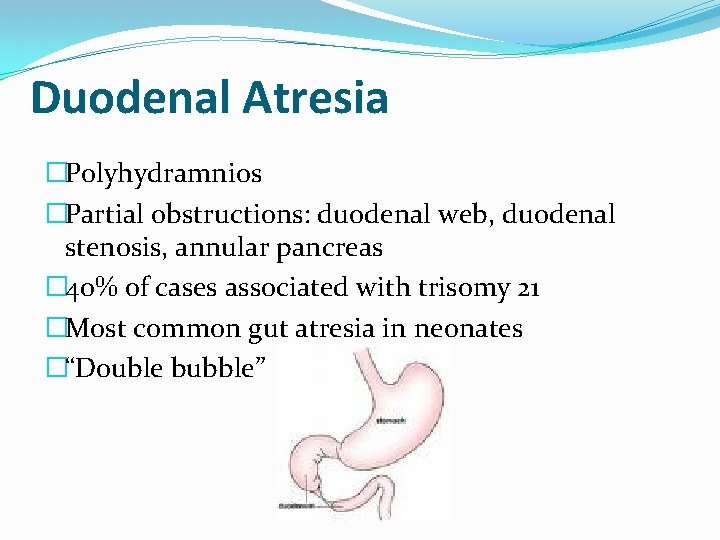 Duodenal Atresia �Polyhydramnios �Partial obstructions: duodenal web, duodenal stenosis, annular pancreas � 40% of