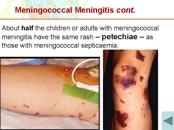 Meningococcal Meningitis cont. About half the children or adults with meningococcal meningitis have the