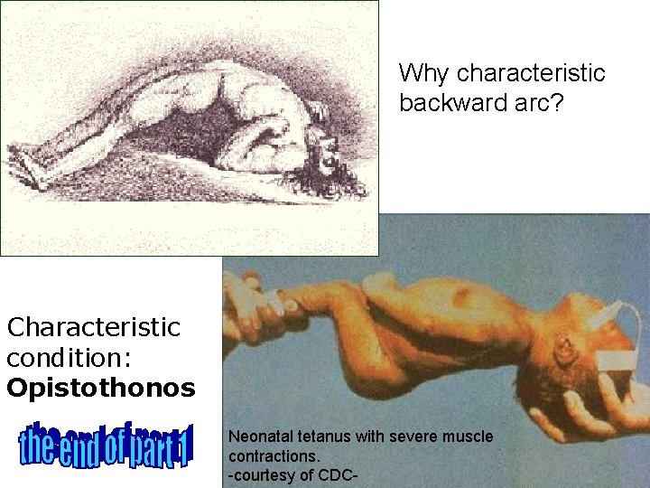 Why characteristic backward arc? Characteristic condition: Opistothonos Neonatal tetanus with severe muscle contractions. -courtesy